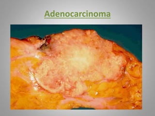 Adenocarcinoma
 