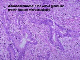 Adenocarcinoma: One with a glandular
growth pattern microscopically.
 