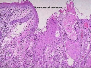 Squamous cell carcinoma
 