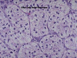 Clear Cells Renal Carcinoma
 