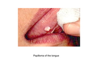 Papilloma of the tongue
 