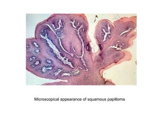 Microscopical appearance of squamous papilloma
 