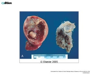 Downloaded from: Robbins & Cotran Pathologic Basis of Disease (on 28 July 2005 03:41 PM)
© 2005 Elsevier
 