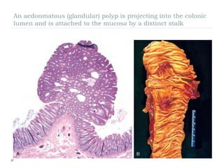 An aedonmatous (glandular) polyp is projecting into the colonic
lumen and is attached to the mucosa by a distinct stalk
 