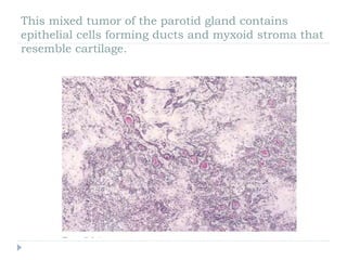 This mixed tumor of the parotid gland contains
epithelial cells forming ducts and myxoid stroma that
resemble cartilage.
 