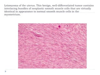 Leiomyoma of the uterus. This benign, well-differentiated tumor contains
interlacing bundles of neoplastic smooth muscle cells that are virtually
identical in appearance to normal smooth muscle cells in the
myometrium.
 