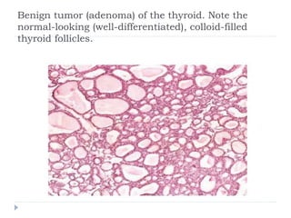 Benign tumor (adenoma) of the thyroid. Note the
normal-looking (well-differentiated), colloid-filled
thyroid follicles.
 