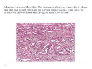 Adenocarcinoma of the colon. The cancerous glands are irregular in shape
and size and do not resemble the normal colonic glands. This tumor is
considered differentiated because gland formation is seen.
 