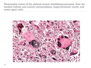 Pleomorphic tumor of the skeletal muscle (rhabdomyosarcoma). Note the
marked cellular and nuclear pleomorphism, hyperchromatic nuclei, and
tumor giant cells.
 
