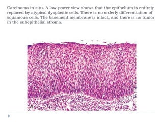 Carcinoma in situ. A low-power view shows that the epithelium is entirely
replaced by atypical dysplastic cells. There is no orderly differentiation of
squamous cells. The basement membrane is intact, and there is no tumor
in the subepithelial stroma.
 