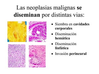 Las neoplasias malignas se 
diseminan por distintas vias: 
· Siembra en cavidades 
corporales 
· Diseminación 
hemática 
· Diseminación 
linfática 
· Invasión perineural 
 