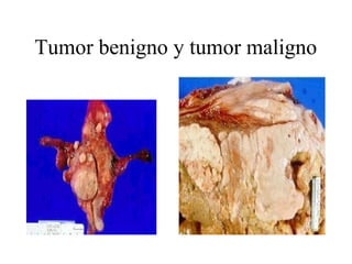 Tumor benigno y tumor maligno 
 