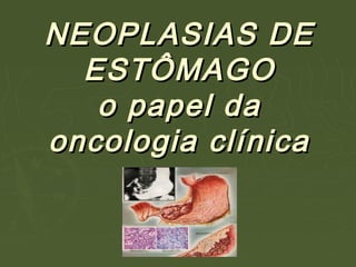 NEOPLASIAS DENEOPLASIAS DE
ESTÔMAGOESTÔMAGO
o papel dao papel da
oncologia clínicaoncologia clínica
 