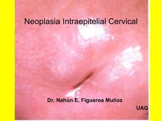 Neoplasia Intraepitelial Cervical
Dr. Nahún E. Figueroa Muñoz
UAG
1
 