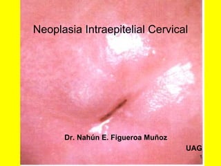 Neoplasia Intraepitelial Cervical ,[object Object],[object Object],[object Object]