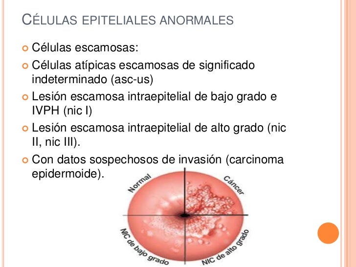 Neoplasia intraepitelial cervical (leibg y leiag)