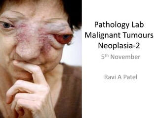 Pathology LabMalignant TumoursNeoplasia-2 5th November Ravi A Patel 