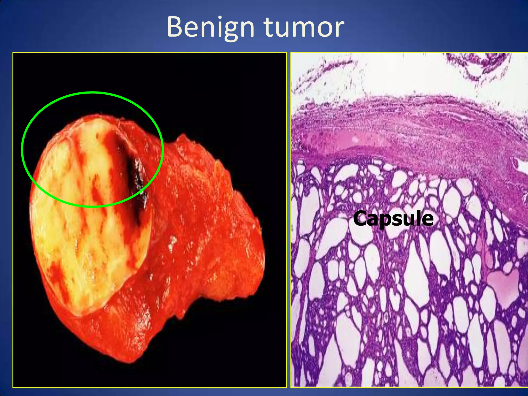 Benign tumor

Capsule

 