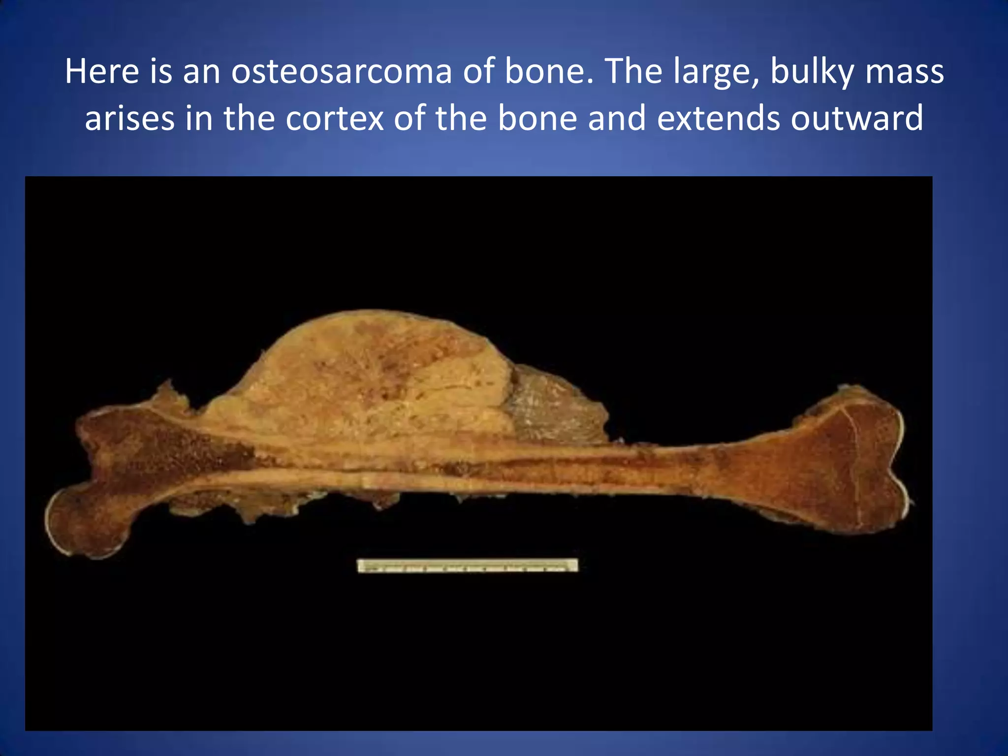 Here is an osteosarcoma of bone. The large, bulky mass
arises in the cortex of the bone and extends outward

 