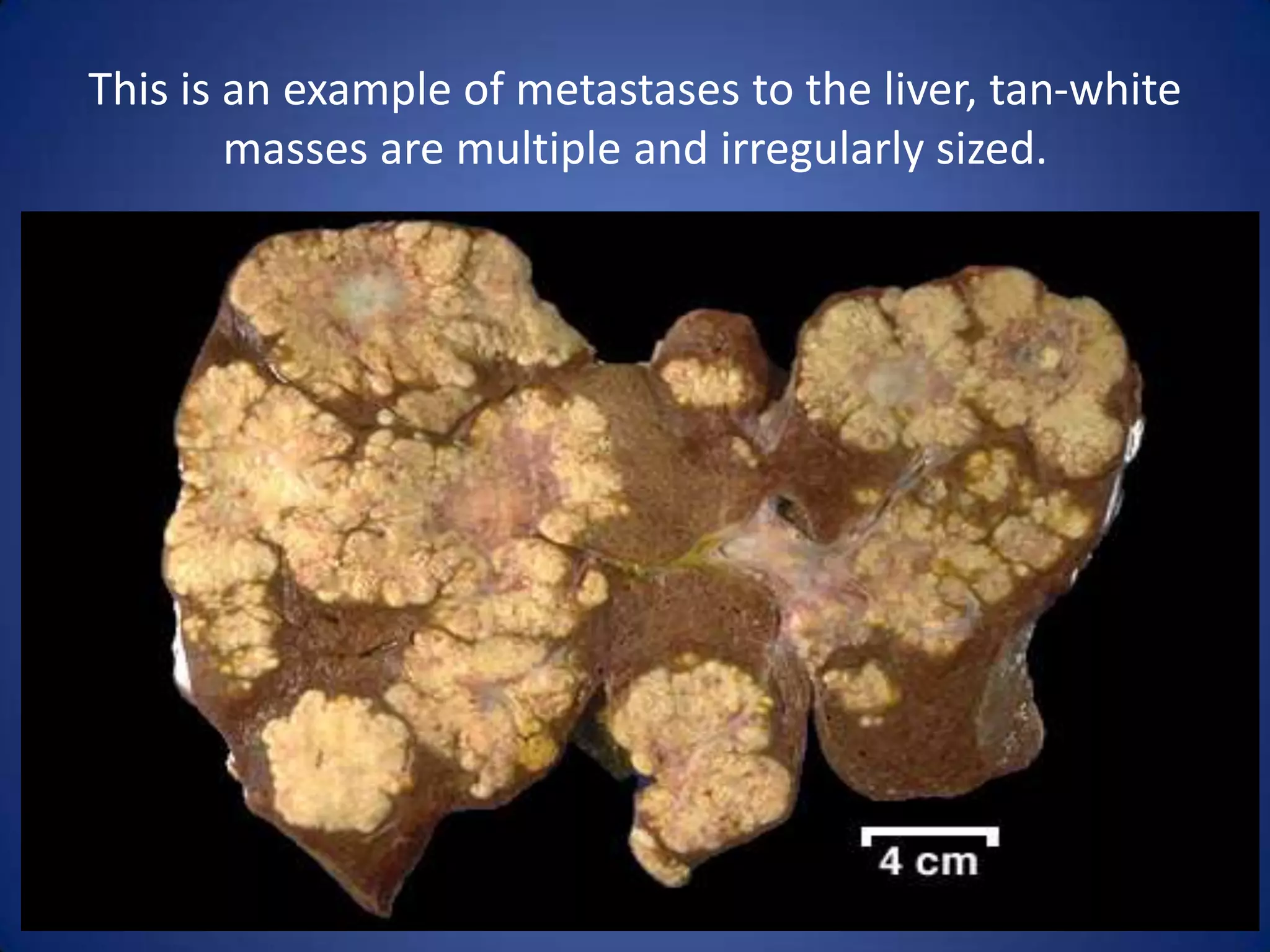This is an example of metastases to the liver, tan-white
masses are multiple and irregularly sized.

 