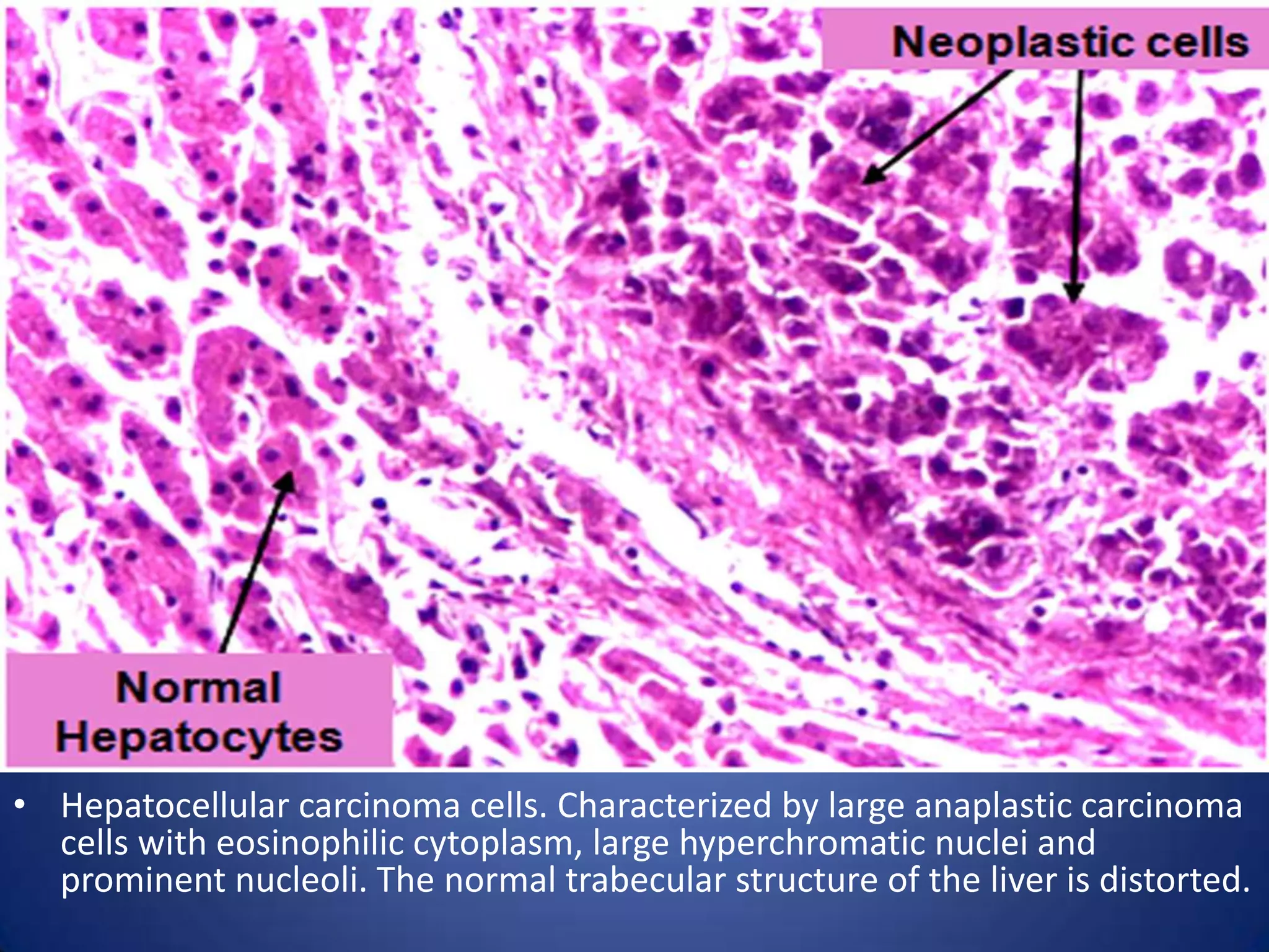 • Hepatocellular carcinoma cells. Characterized by large anaplastic carcinoma
cells with eosinophilic cytoplasm, large hyperchromatic nuclei and
prominent nucleoli. The normal trabecular structure of the liver is distorted.

 
