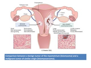 Comparison between a benign tumor of the myometrium (leiomyoma) and a
malignant tumor of similar origin (leiomyosarcoma).
 