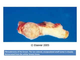 Fibroadenoma of the breast. The tan-colored, encapsulated small tumor is sharply
demarcated from the whiter breast tissue.
 
