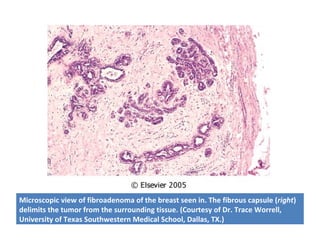 Microscopic view of fibroadenoma of the breast seen in. The fibrous capsule (right)
delimits the tumor from the surrounding tissue. (Courtesy of Dr. Trace Worrell,
University of Texas Southwestern Medical School, Dallas, TX.)
 