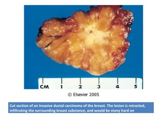 Cut section of an invasive ductal carcinoma of the breast. The lesion is retracted,
infiltrating the surrounding breast substance, and would be stony hard on
palpation.
 