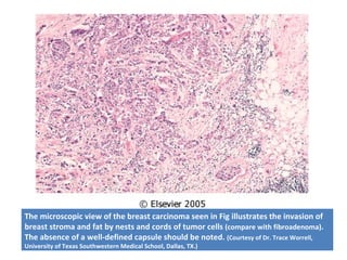 The microscopic view of the breast carcinoma seen in Fig illustrates the invasion of
breast stroma and fat by nests and cords of tumor cells (compare with fibroadenoma).
The absence of a well-defined capsule should be noted. (Courtesy of Dr. Trace Worrell,
University of Texas Southwestern Medical School, Dallas, TX.)
 