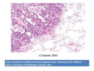 Colon carcinoma invading pericolonic adipose tissue. (Courtesy of Dr. Melissa
Upton, University of Washington, Seattle, WA.)
 