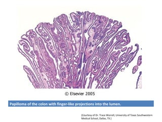 Papilloma of the colon with finger-like projections into the lumen.

                                           (Courtesy of Dr. Trace Worrell, University of Texas Southwestern
                                           Medical School, Dallas, TX.)
 