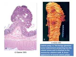 Colonic polyp. A, This benign glandular
tumor (adenoma) is projecting into the
colonic lumen and is attached to the
mucosa by a distinct stalk. B, Gross
appearance of several colonic polyps
 