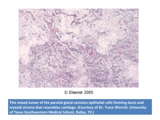 This mixed tumor of the parotid gland contains epithelial cells forming ducts and
myxoid stroma that resembles cartilage. (Courtesy of Dr. Trace Worrell, University
of Texas Southwestern Medical School, Dallas, TX.)
 
