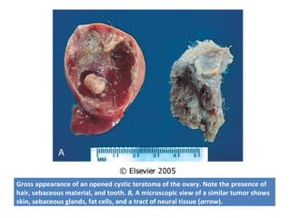 Gross appearance of an opened cystic teratoma of the ovary. Note the presence of
hair, sebaceous material, and tooth. B, A microscopic view of a similar tumor shows
skin, sebaceous glands, fat cells, and a tract of neural tissue (arrow).
 