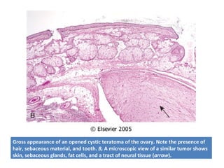 Gross appearance of an opened cystic teratoma of the ovary. Note the presence of
hair, sebaceous material, and tooth. B, A microscopic view of a similar tumor shows
skin, sebaceous glands, fat cells, and a tract of neural tissue (arrow).
 