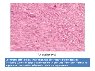 Leiomyoma of the uterus. This benign, well-differentiated tumor contains
interlacing bundles of neoplastic smooth muscle cells that are virtually identical in
appearance to normal smooth muscle cells in the myometrium.
 