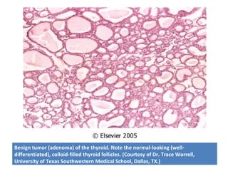 Benign tumor (adenoma) of the thyroid. Note the normal-looking (well-
differentiated), colloid-filled thyroid follicles. (Courtesy of Dr. Trace Worrell,
University of Texas Southwestern Medical School, Dallas, TX.)
 