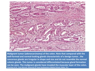Malignant tumor (adenocarcinoma) of the colon. Note that compared with the
well-formed and normal-looking glands characteristic of a benign tumor , the
cancerous glands are irregular in shape and size and do not resemble the normal
colonic glands. This tumor is considered differentiated because gland formation
can be seen. The malignant glands have invaded the muscular layer of the colon.
(Courtesy of Dr. Trace Worrell, University of Texas Southwestern Medical School, Dallas, TX.)
 