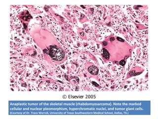 Anaplastic tumor of the skeletal muscle (rhabdomyosarcoma). Note the marked
cellular and nuclear pleomorphism, hyperchromatic nuclei, and tumor giant cells.
(Courtesy of Dr. Trace Worrell, University of Texas Southwestern Medical School, Dallas, TX.)
 