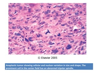 Anaplastic tumor showing cellular and nuclear variation in size and shape. The
prominent cell in the center field has an abnormal tripolar spindle.
 