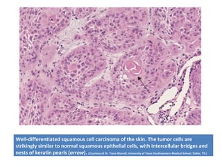 Well-differentiated squamous cell carcinoma of the skin. The tumor cells are
strikingly similar to normal squamous epithelial cells, with intercellular bridges and
nests of keratin pearls (arrow). (Courtesy of Dr. Trace Worrell, University of Texas Southwestern Medical School, Dallas, TX.)
 
