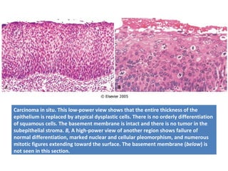 Carcinoma in situ. This low-power view shows that the entire thickness of the
epithelium is replaced by atypical dysplastic cells. There is no orderly differentiation
of squamous cells. The basement membrane is intact and there is no tumor in the
subepithelial stroma. B, A high-power view of another region shows failure of
normal differentiation, marked nuclear and cellular pleomorphism, and numerous
mitotic figures extending toward the surface. The basement membrane (below) is
not seen in this section.
 