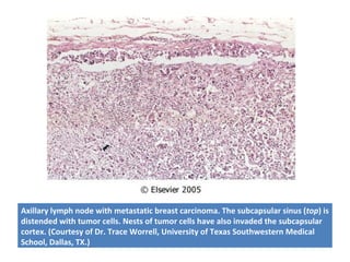 Axillary lymph node with metastatic breast carcinoma. The subcapsular sinus (top) is
distended with tumor cells. Nests of tumor cells have also invaded the subcapsular
cortex. (Courtesy of Dr. Trace Worrell, University of Texas Southwestern Medical
School, Dallas, TX.)
 