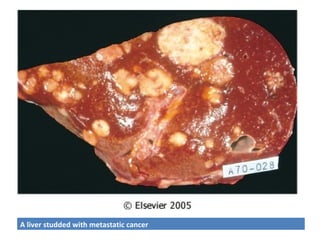 A liver studded with metastatic cancer
 