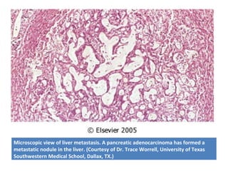 Microscopic view of liver metastasis. A pancreatic adenocarcinoma has formed a
metastatic nodule in the liver. (Courtesy of Dr. Trace Worrell, University of Texas
Southwestern Medical School, Dallax, TX.)
 