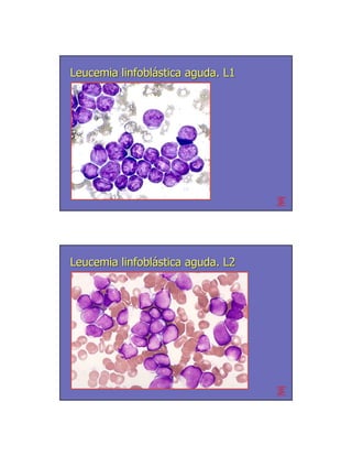 Leucemia linfoblástica aguda. L1




Leucemia linfoblástica aguda. L2
 