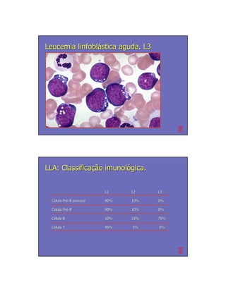 Leucemia linfoblástica aguda. L3




LLA: Classificação imunológica.


                         L1    L2    L3

  Célula Pré-B precoce
         Pré             90%   10%   0%

  Célula Pré-B
         Pré             90%   10%   0%

  Célula B               10%   15%   75%

  Célula T               95%   5%    0%
 