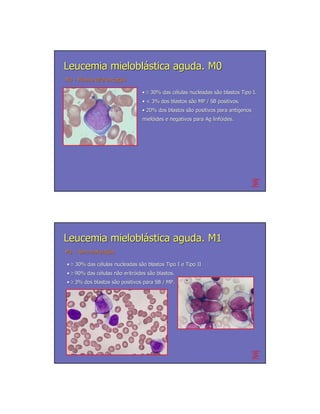Leucemia mieloblástica aguda. M0
M0 - Mínima diferenciação
            diferenciação

                                • ≥ 30% das células nucleadas são blastos Tipo I.
                                            cé                sã
                                • < 3% dos blastos são MP / SB positivos.
                                                   sã
                                • 20% dos blastos são positivos para antígenos
                                                  sã                 antí
                                mielóides e negativos para Ag linfóides.
                                mieló                         linfó




Leucemia mieloblástica aguda. M1
M1 – Sem maturação
         maturação

• ≥ 30% das células nucleadas são blastos Tipo I e Tipo II
            cé                sã
• ≥ 90% das células não eritróides são blastos.
            cé      nã eritró      sã
• ≥ 3% dos blastos são positivos para SB / MP.
                   sã
 