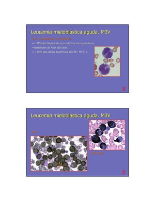 Leucemia mieloblástica aguda. M3V
M3V - Promielocítica microgranular
      Promielocí
• ≥ 30% dos blastos são promielócitos microgranulares.
                    sã promieló
• Bastonetes de Auer são raros.
                     sã
• > 85% das células leucêmicas são SB / MP (+).
            cé      leucê      sã




Leucemia mieloblástica aguda. M3V


MPO




                                                  Sudan Black
 